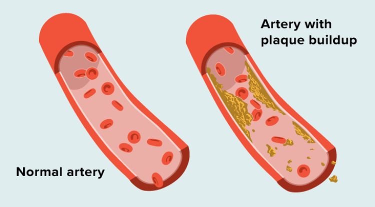 Atherosclerosis Symptoms