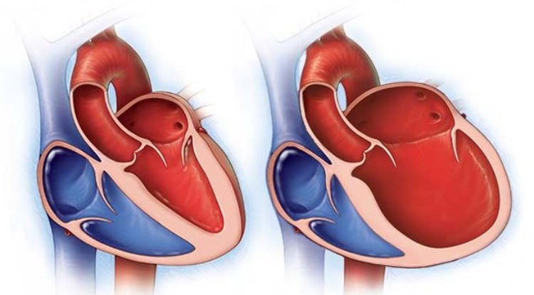 Cardiomyopathy Symptoms