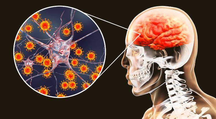 Encephalitis Symptoms