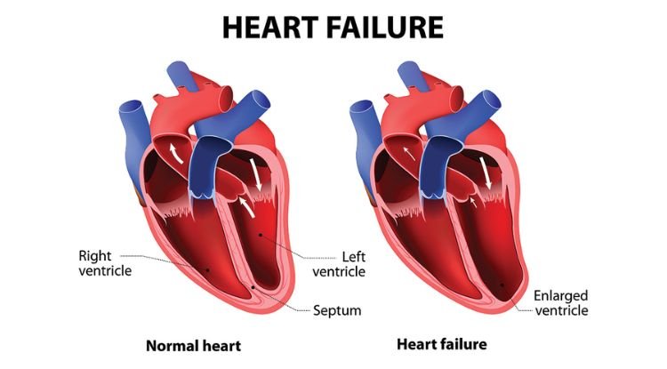 Heart Failure Symptoms