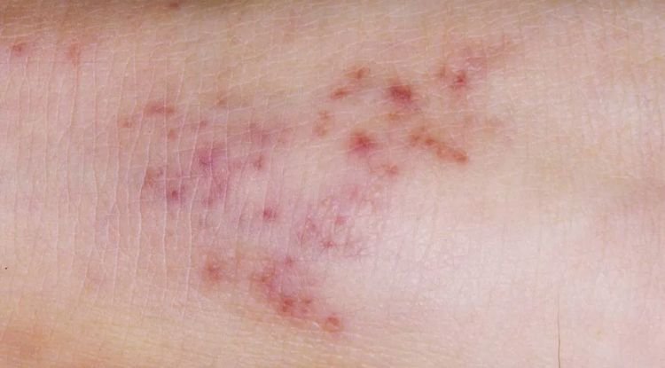 Meningitis Symptoms