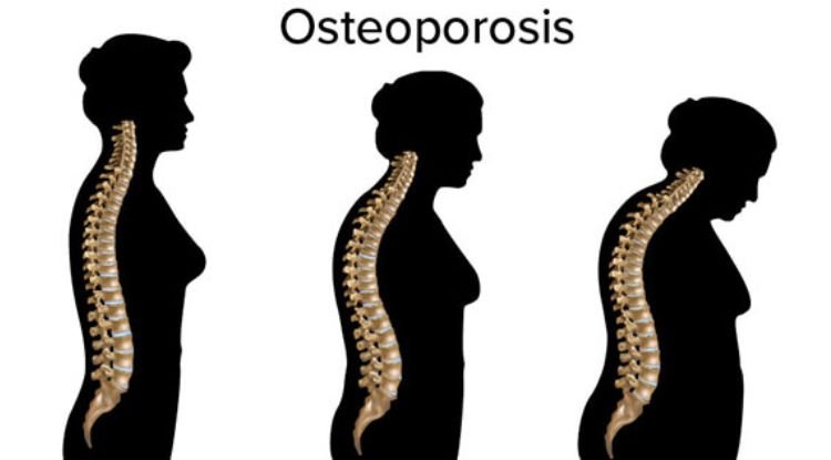 Osteoporosis Symptoms