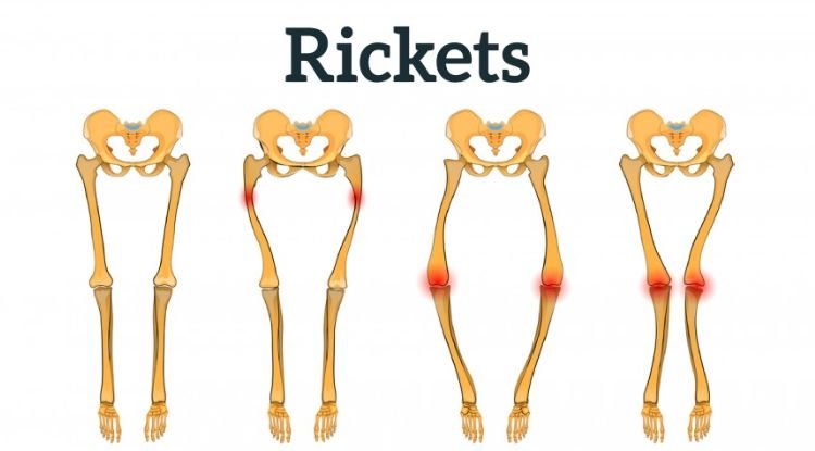 Rickets Symptoms