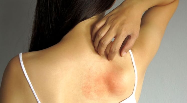 Vasculitis Symptoms