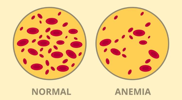 Anemia Symptoms