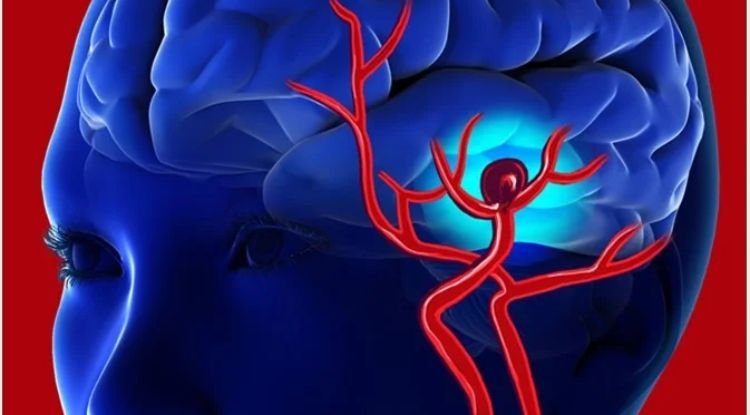 Aneurysms Symptoms
