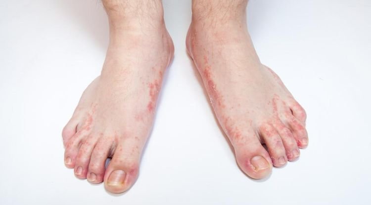 Athlete's Foot Symptoms