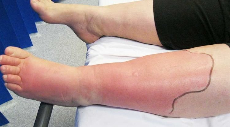 Cellulitis Symptoms