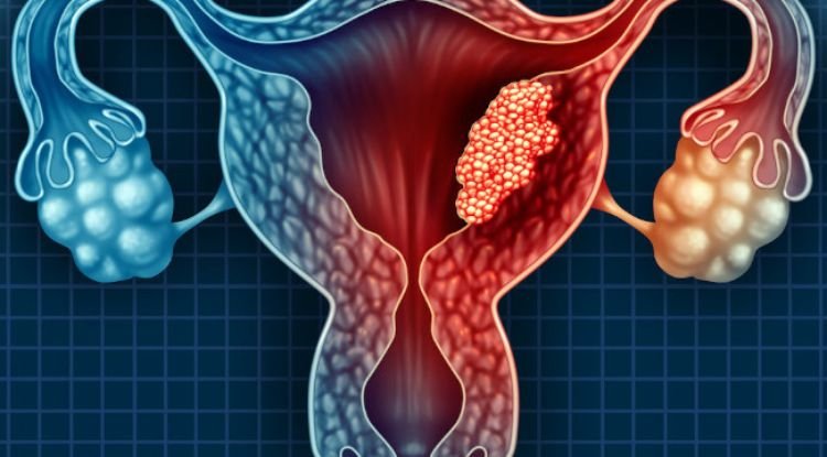Cervical Cancer Symptoms