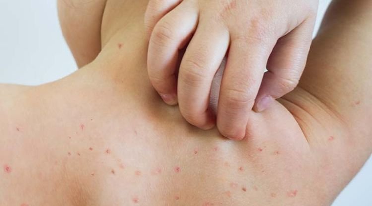Chickenpox Symptoms