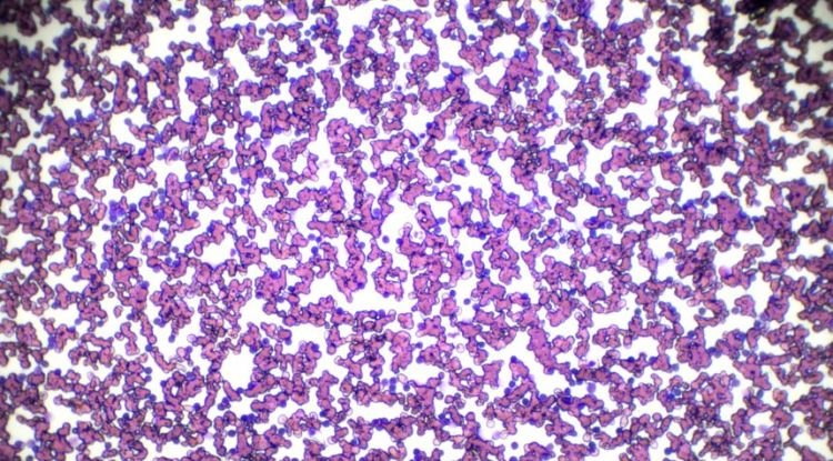 Chronic Lymphocytic Leukemia Symptoms