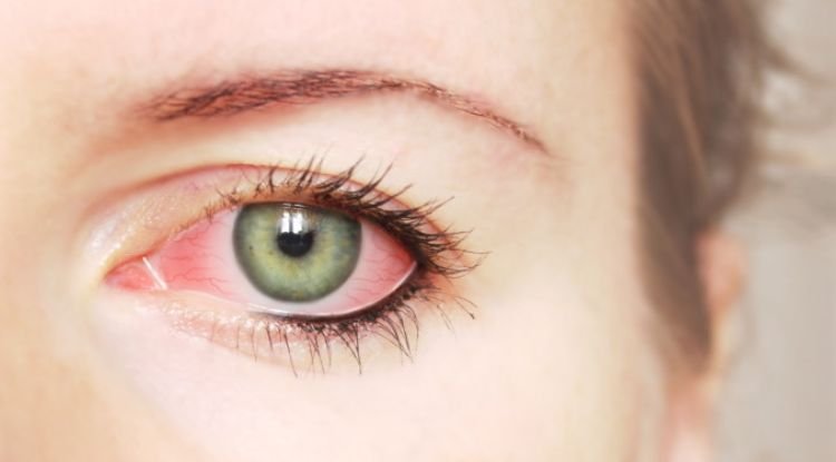 Glaucoma Symptoms
