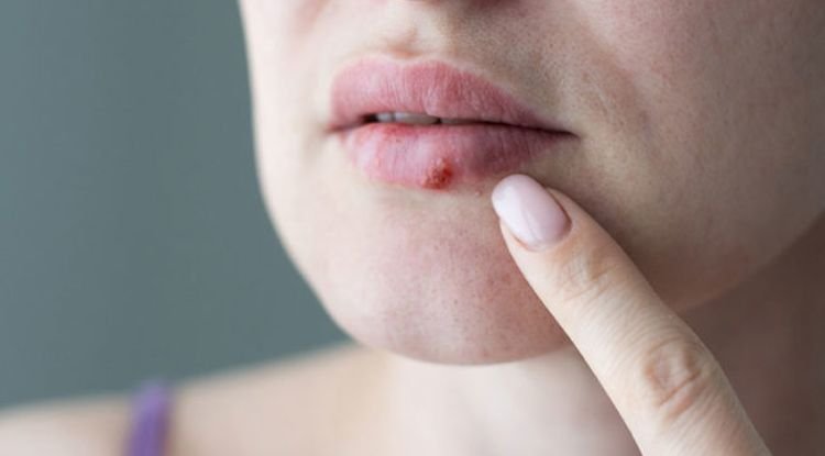 Herpes Symptoms
