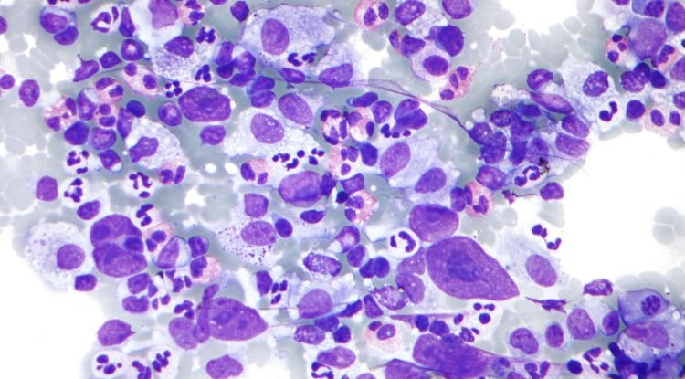 Hodgkin Lymphoma Symptoms
