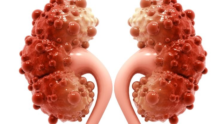 Kidney Cysts Symptoms