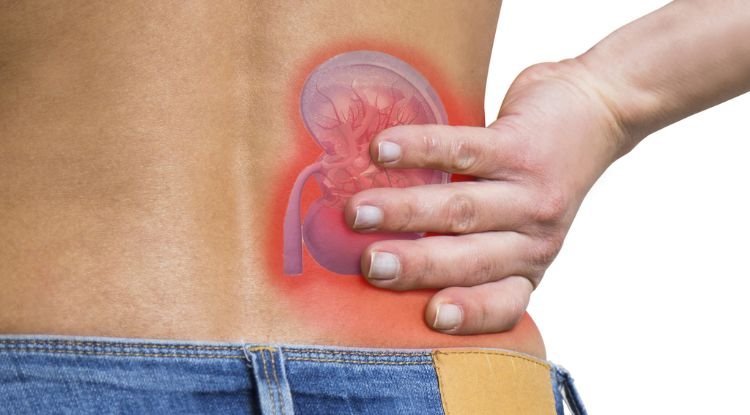 Kidney Stones Symptoms