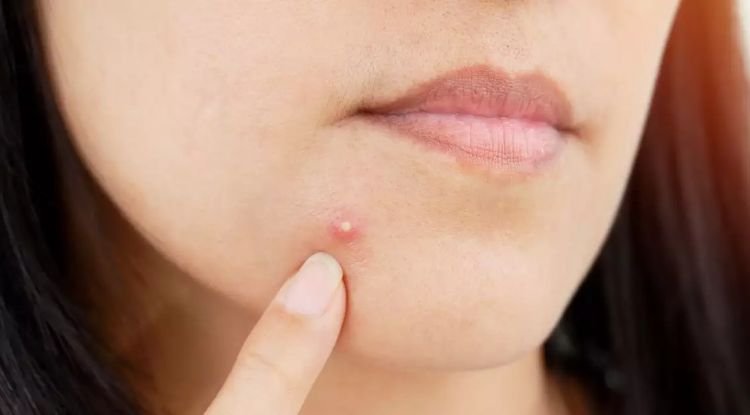Melanoma Cancer Symptoms