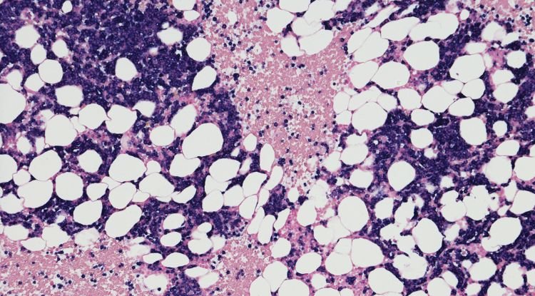Multiple Myeloma Symptoms