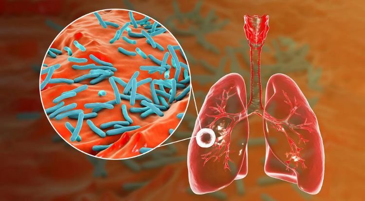 Mycobacterium Tuberculosis Symptoms