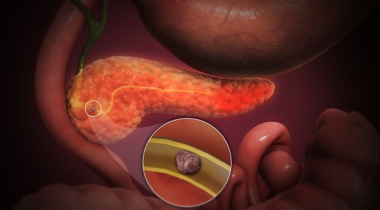 Pancreatitis Symptoms