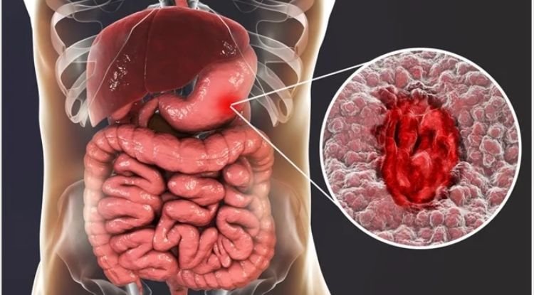 Peptic Ulcers Symptoms