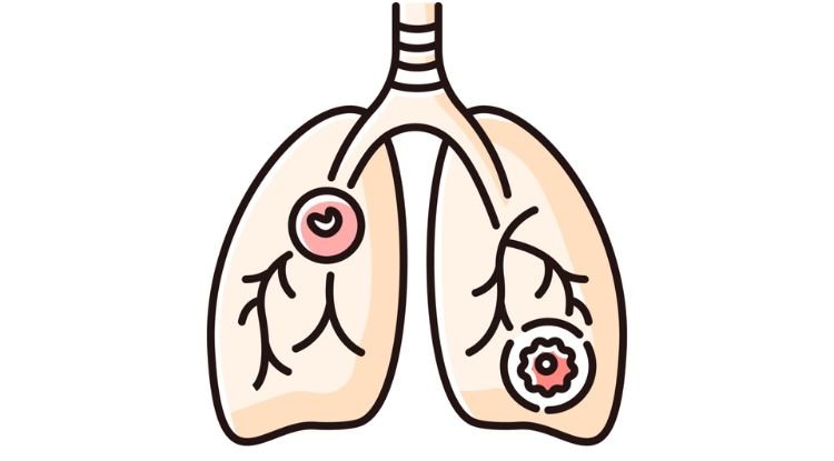 Pneumonia Panel Symptoms