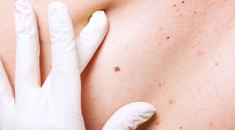 Skin Cancer Symptoms