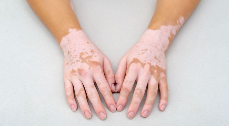 Vitiligo Symptoms
