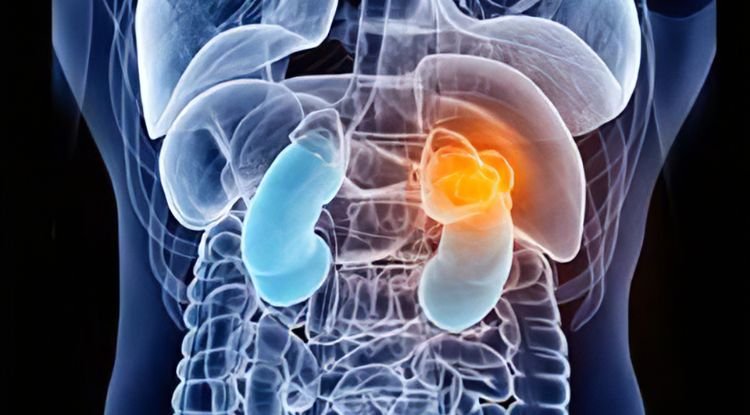 Wilms Tumor Symptoms