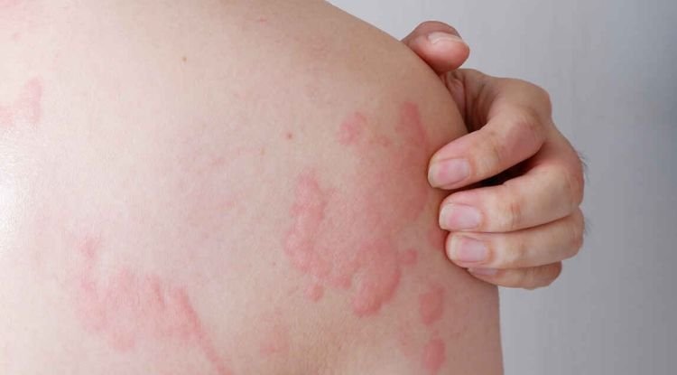 Allergy Symptoms